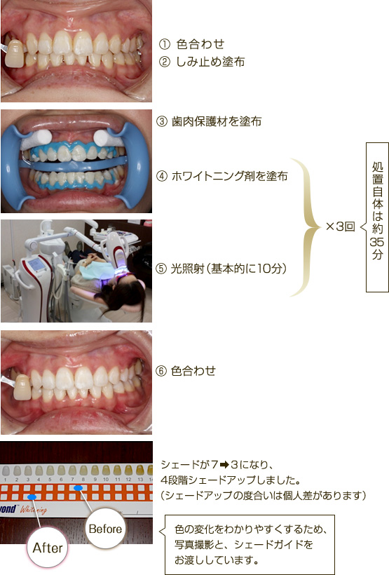 ホワイトニング・施術の流れ