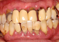 歯周病　重度の症状